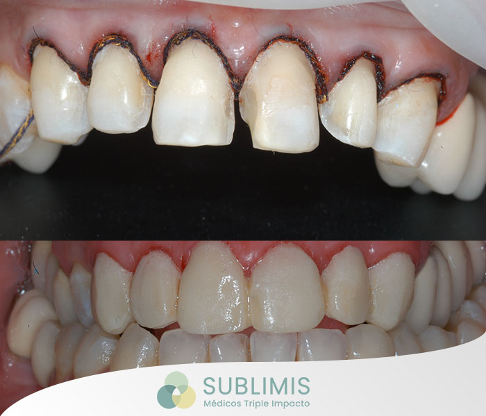 Fotos de Antes y Después de Carillas Dentales de Porcelana