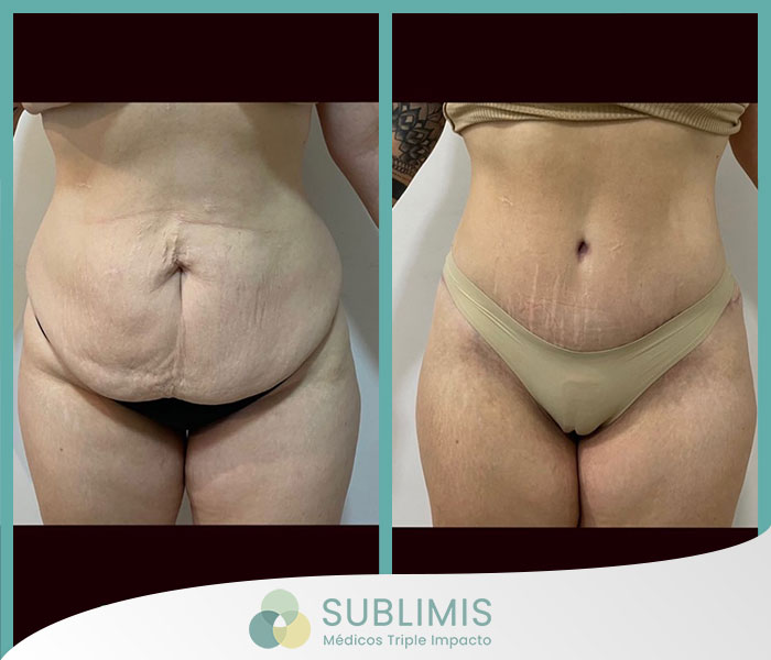 Abdominoplastia, fotos de antes y después