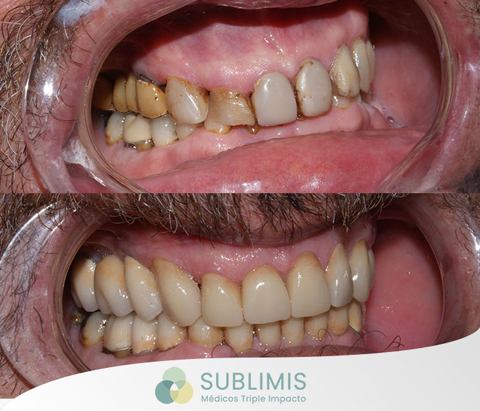 Antes y después de implantes dentales