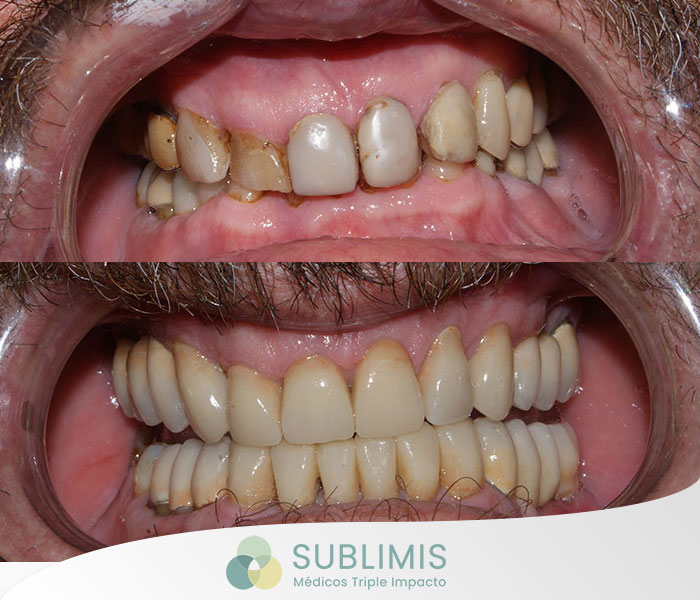 Antes y después de implantes dentales