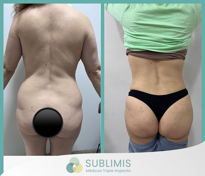 Antes y después de una lipoescultura.