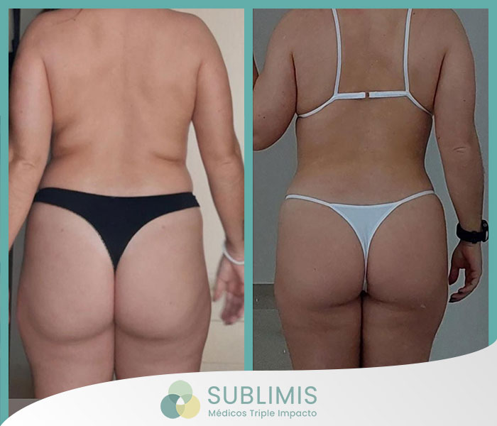 Antes y después de una liposucción