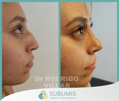 Antes y Después de una Rinoplastia