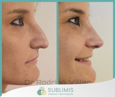 Antes y Después de una Rinoplastia