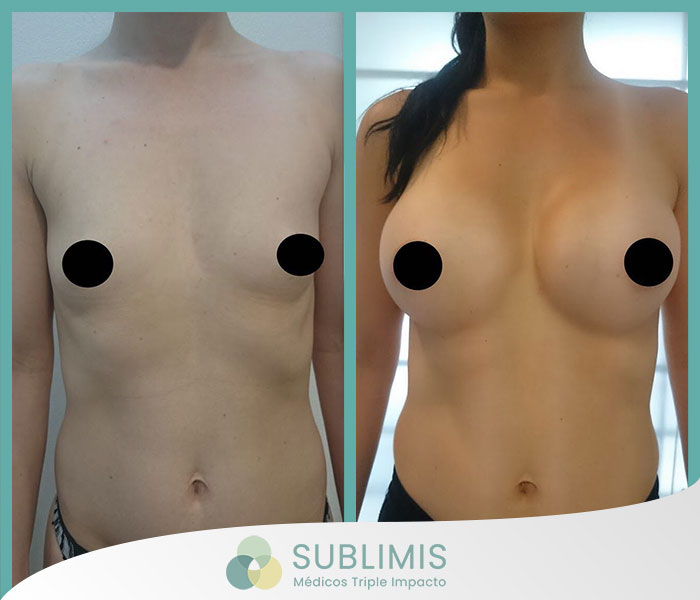 1- Fotos de frente antes y después de una cirugía de aumento de mamas de una mujer de 18 años con prótesis Mentor de 330cc