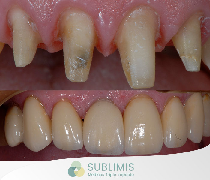 Before and after porcelain crowns