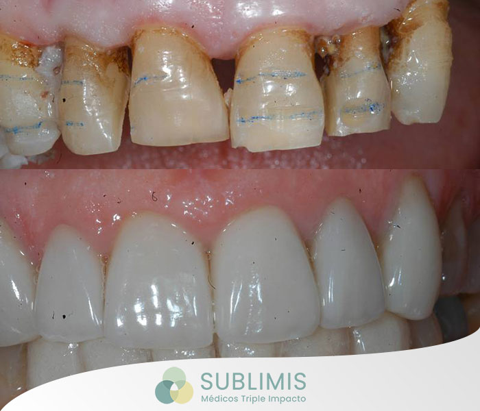 Porcelain Veneers, before & after