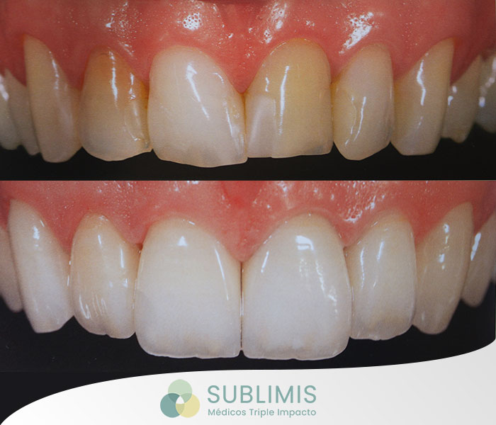 Carillas Dentales, antes y después