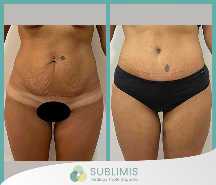 Cirugía de abdomen, fotos de antes y después