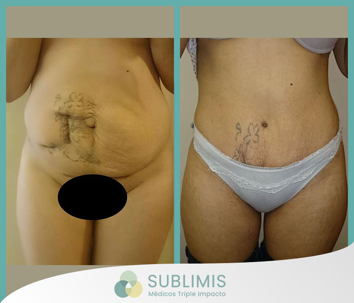 Before and after a tummy tuck.