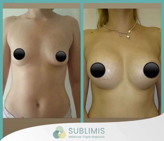 2- Fotos de frente y perfil izquierdo antes y después de una cirugía de aumento de mamas de una mujer de 18 años con prótesis Mentor de 330cc
