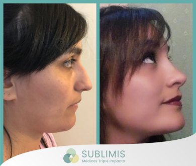 Cirugía de Nariz en Mujeres