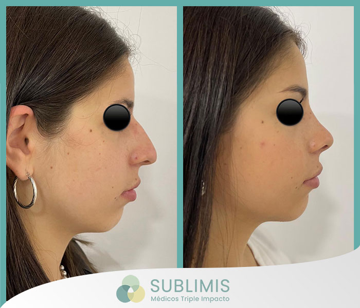 Fotos de Cirugía Estética de Nariz