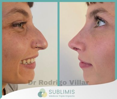 Cirugía de Nariz, Antes y Después