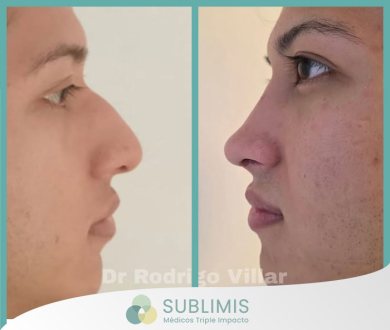 Cirugía de Nariz, Antes y Después