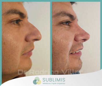 Cirugía de Nariz en Hombres