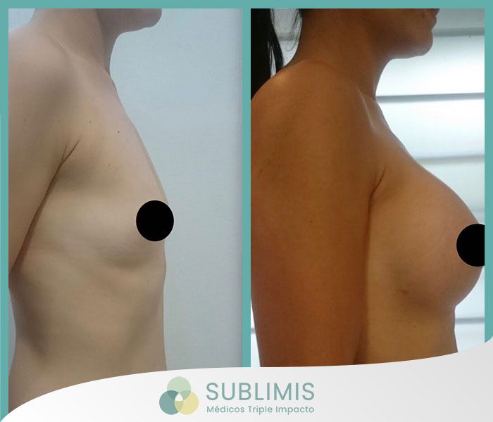 Imagen de perfil izquierdo de una mujer de 21 años antes y después de un aumento de mamas.