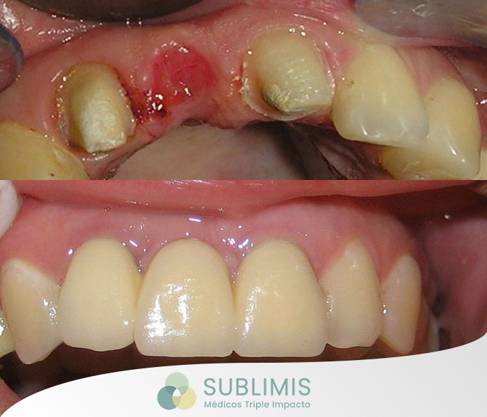 Antes y después de coronas de porcelanas sobre metal