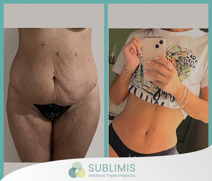 Abdominoplasty, before and after