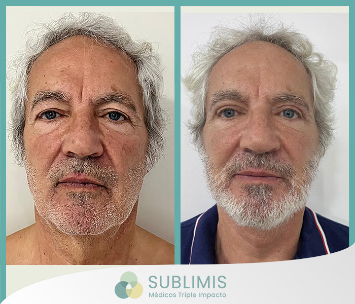 Antes y después de un facelift.