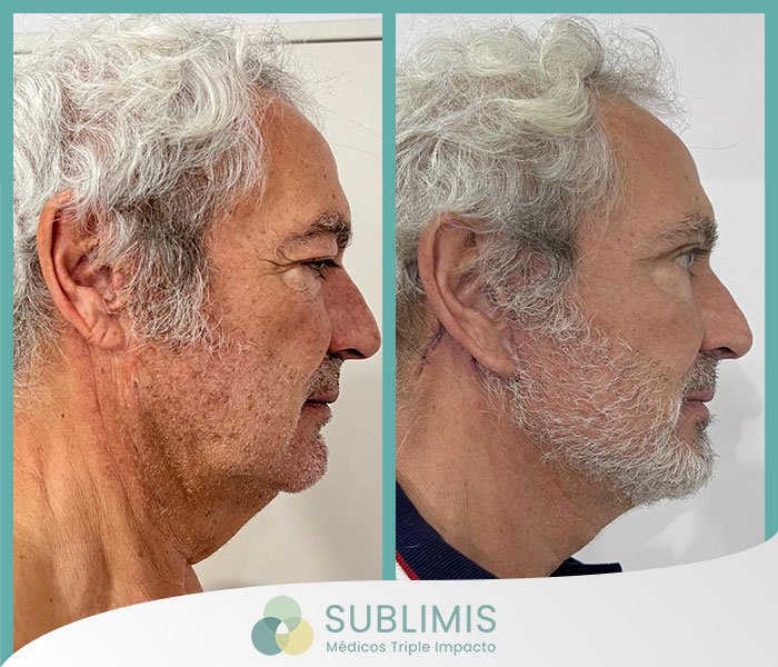 Antes y después de un facelift.