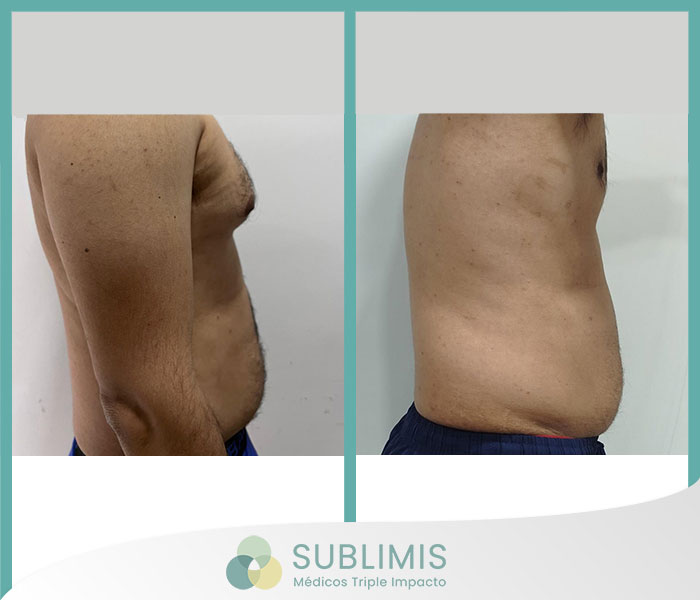 Before and after a gynecomasty.
