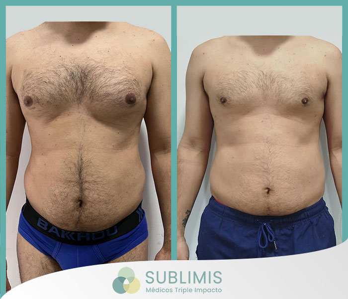 Male breast reduction surgery, before and after.