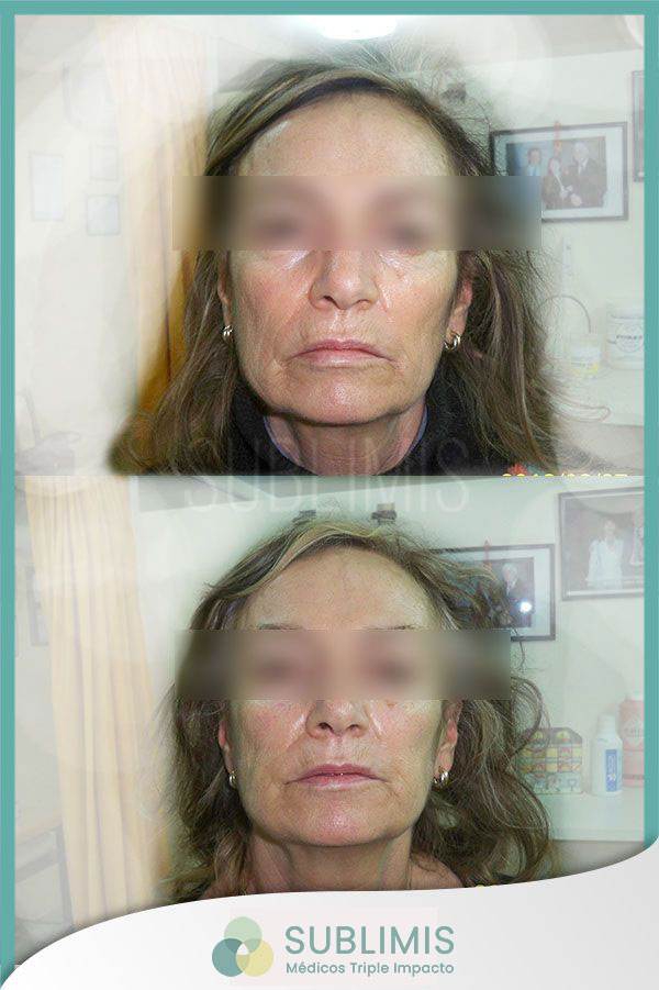 Hilos Tensores Rusos en el rostro