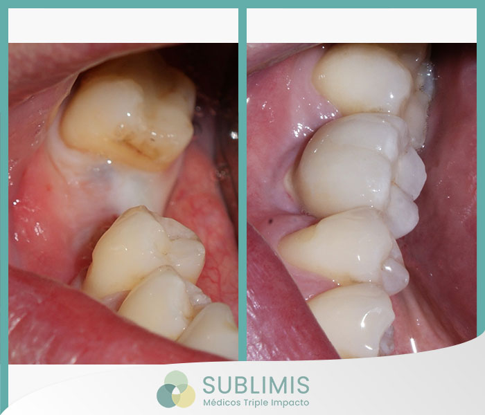 Implante Dental