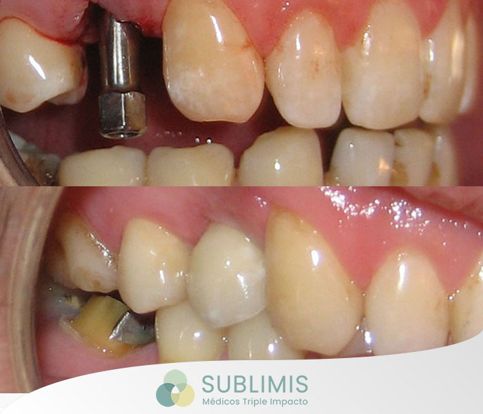 Implantes Dentales