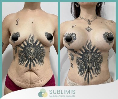 Mujer de 48 años luego de colocarse implantes mamarios de 375cc. Foto de frente.