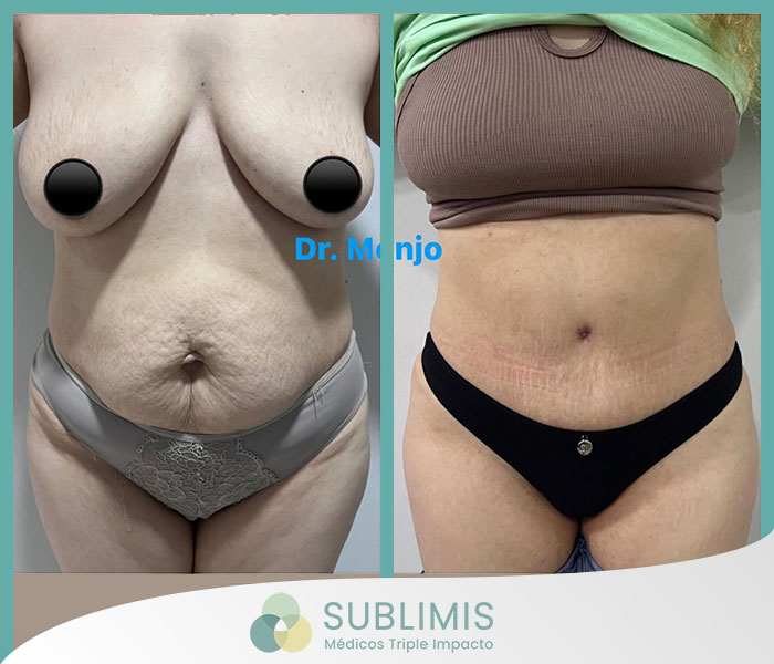 Fotos de antes y después de una liposucción láser.