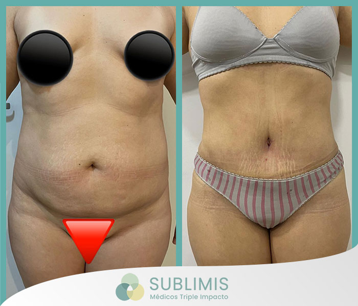 Liposucción Vaser, fotos de antes y después de la cirugía.