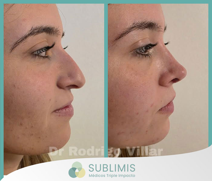 Operación de Nariz, Fotos de Antes y Después