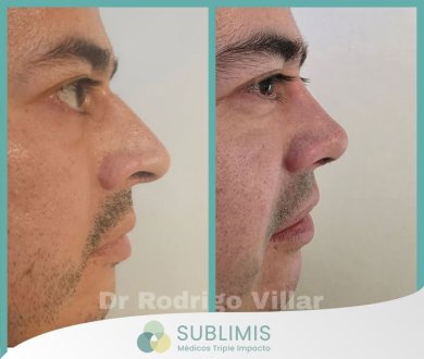 Operación de Nariz, Fotos de Antes y Después