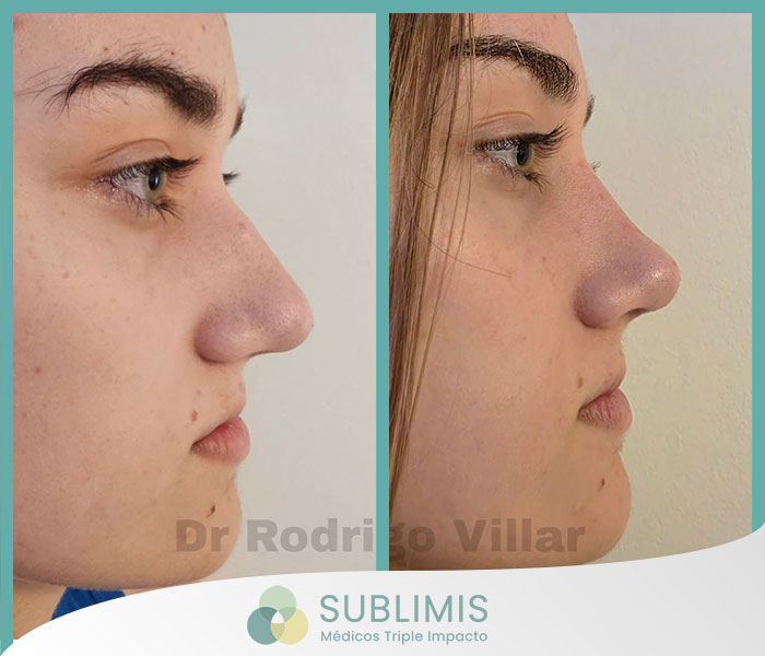 Operación de Nariz en Mujeres