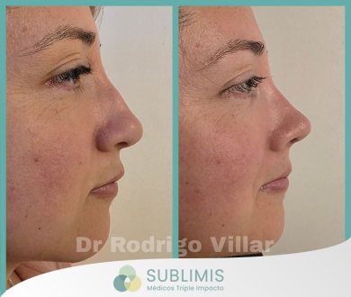 Operación de Nariz en Mujeres