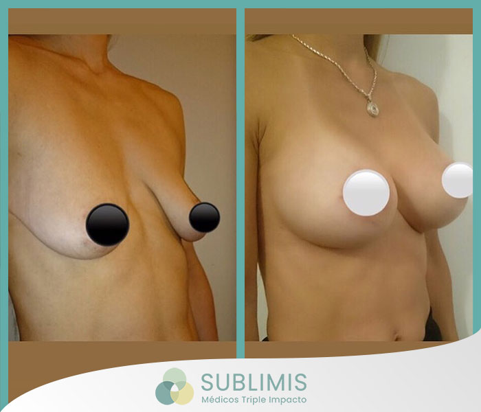 Foto de frente y perfil izquierdo de una mujer de 40 años antes y después de una operación para agrandar los senos.