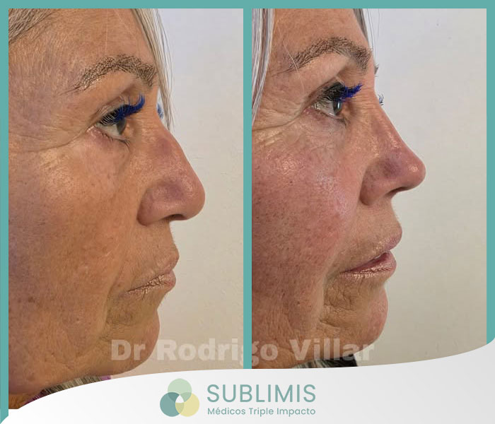 Operación de Tabique