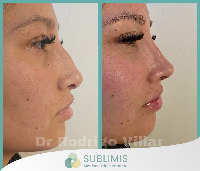 Operación de Tabique