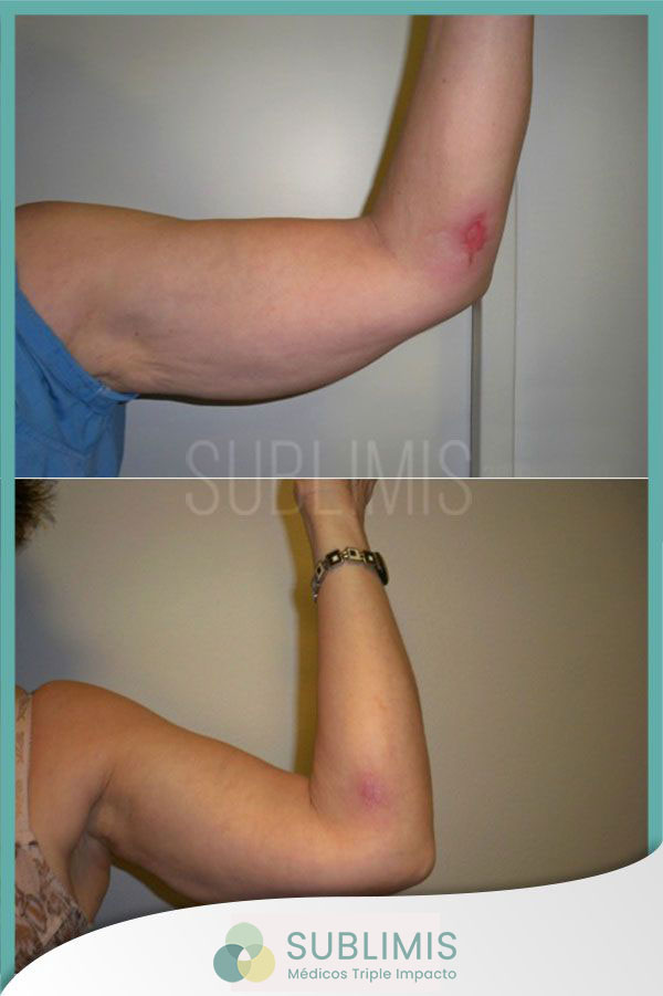 Treatment for burns