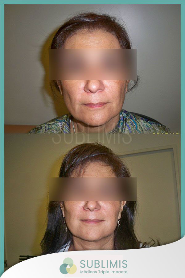 Foto de antes y después de tratamiento para las manchas en el rostro.