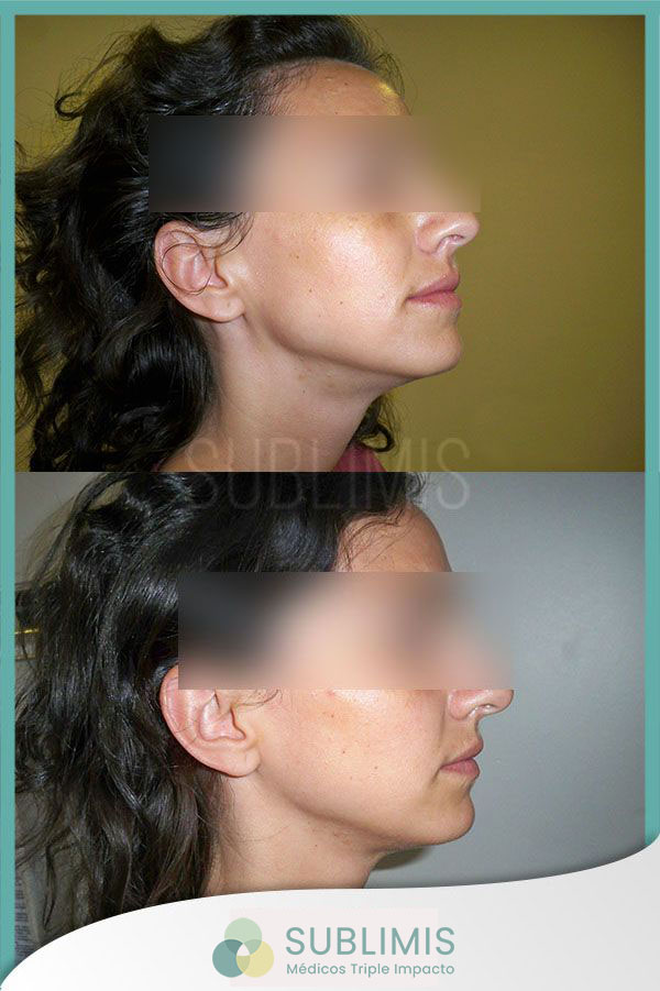 Rejuvenecimiento facial con plasma rico en plaquetas. Foto de perfil derecho de mujer de 27 años.