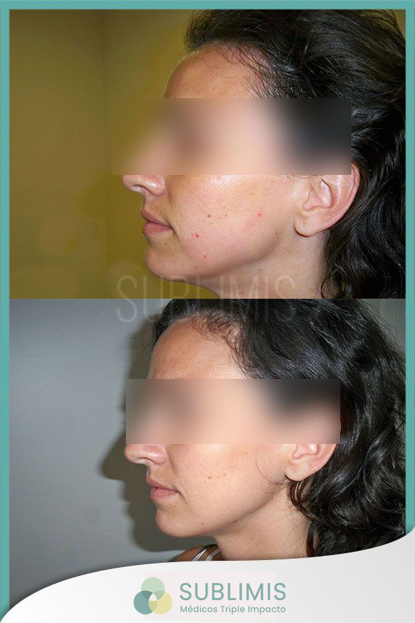 Rejuvenecimiento facial con plasma rico en plaquetas. Foto de perfil izquierdo de mujer de 27 años.
