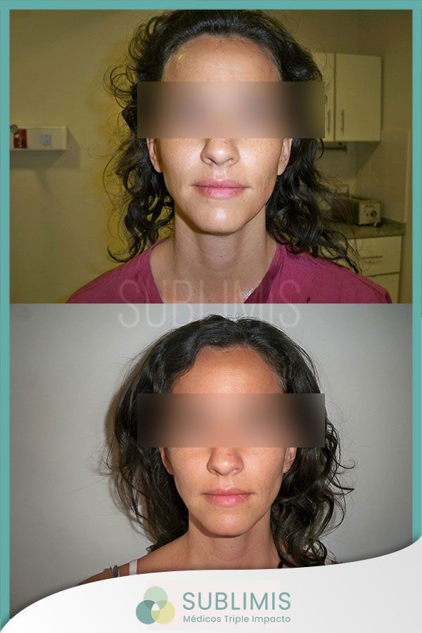 Rejuvenecimiento facial con plasma rico en plaquetas. Foto de frente de mujer de 27 años.