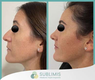 Cirugía Reconstructiva de Nariz.