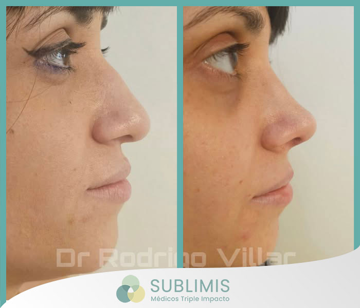 Rinoplastia, Antes y Después