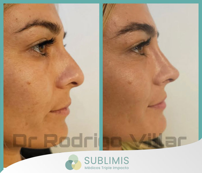 Rinoplastia, Antes y Después