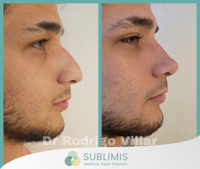 Rinoplastia Correctiva
