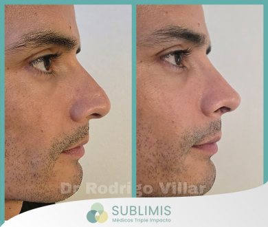Rinoplastia Correctiva